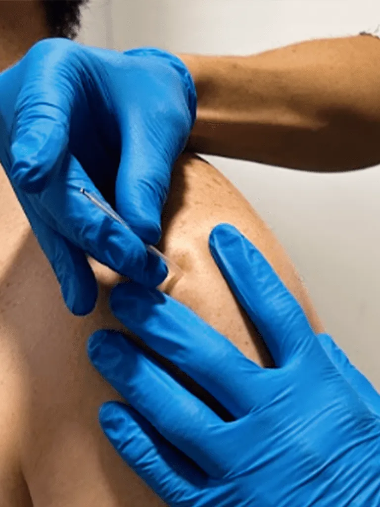 Manos con guantes azules realizando una técnica de fisioterapia invasiva con aguja sobre el hombro de un paciente